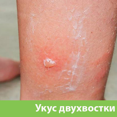 Укус двухвостки в Орехово-Зуево