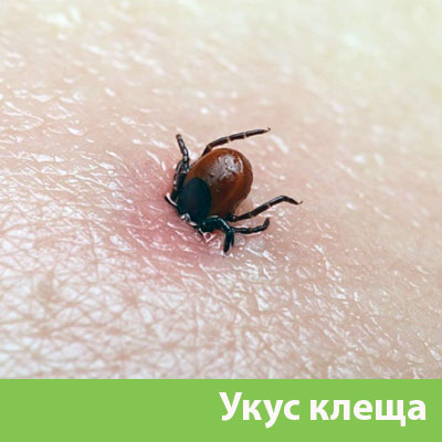 Укус клеща в Орехово-Зуево