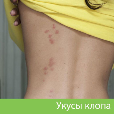 Профессиональное уничтожение клопов в Орехово-Зуево